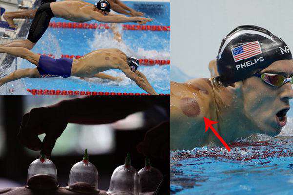 لکه‌های بدن مایکل فلپس قهرمان شنای آمریکا  در المپیک ،به دلیل استفاده از  طب سنتی بادکش است. گفته می شود باد کش کردن عضلات باعث بهبود گردش خون و تسکین درد می شود